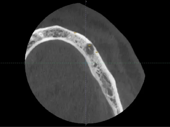مقطع CBCT محوري للفكّ السفلي مرفوع على زيارة المريض