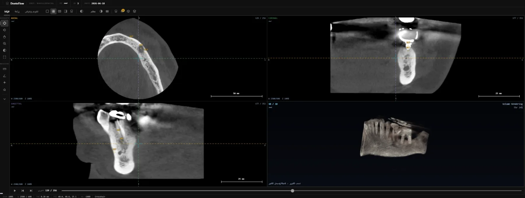 عارض CBCT في دينتو فلو: المقاطع الثلاثة والمجسّم الحجمي لفكّ المريض