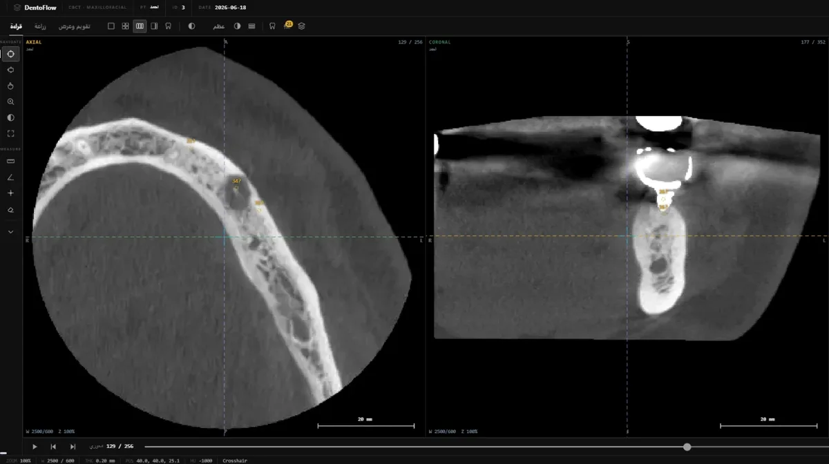 عارض CBCT بأدوات القياس والتنقّل بين الشرائح وأرقام الأسنان المقترحة